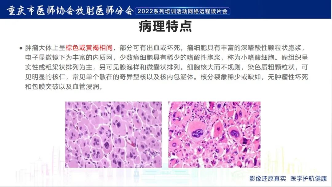 影像PPT - 【病例】肾上腺皮质嗜酸细胞腺瘤1例CT-15