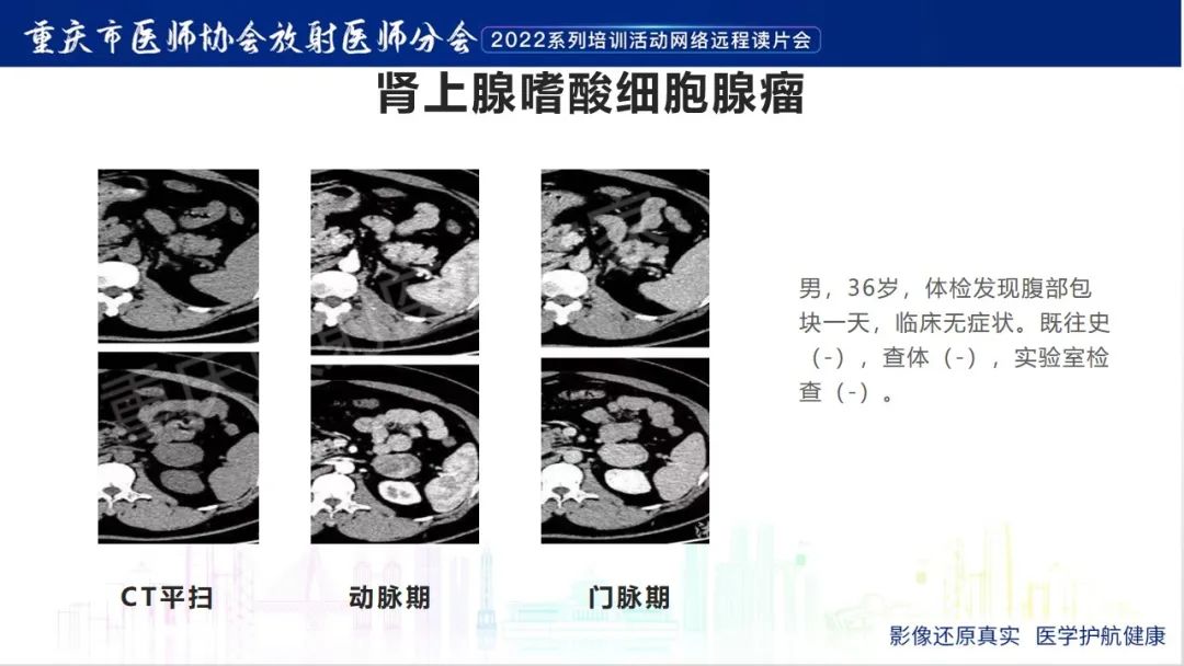 影像PPT - 【病例】肾上腺皮质嗜酸细胞腺瘤1例CT-18