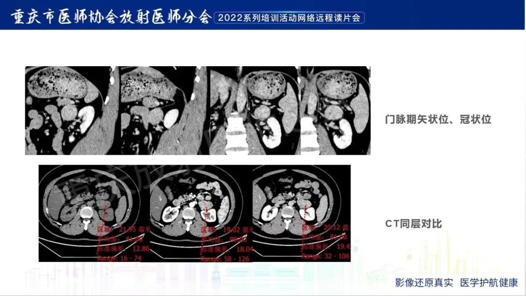 影像PPT - 【病例】肾上腺皮质嗜酸细胞腺瘤1例CT-19