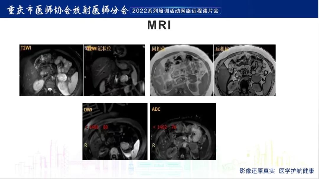 影像PPT - 【病例】肾上腺皮质嗜酸细胞腺瘤1例CT-20