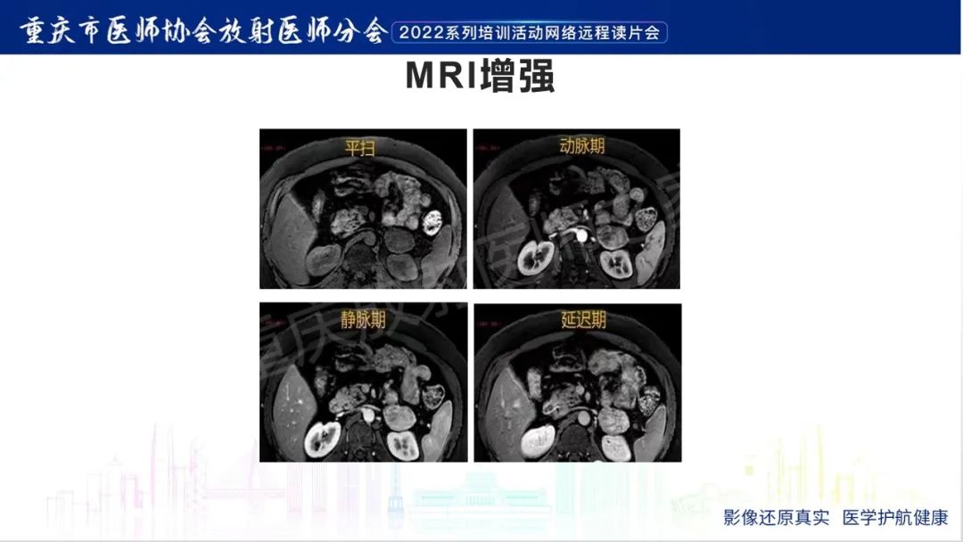 影像PPT - 【病例】肾上腺皮质嗜酸细胞腺瘤1例CT-21
