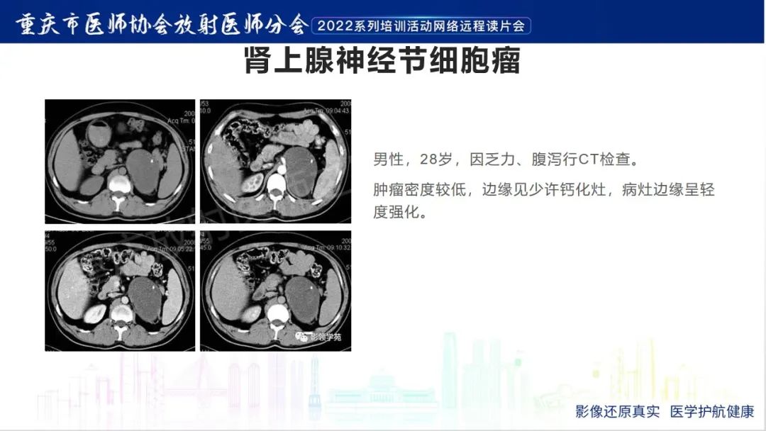 影像PPT - 【病例】肾上腺皮质嗜酸细胞腺瘤1例CT-23