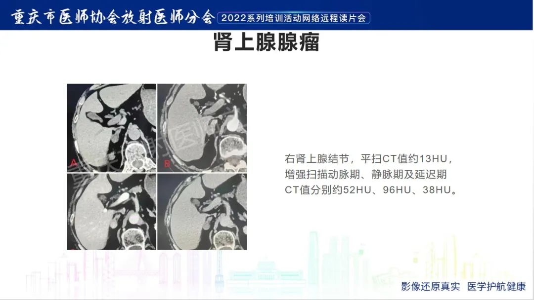 影像PPT - 【病例】肾上腺皮质嗜酸细胞腺瘤1例CT-25