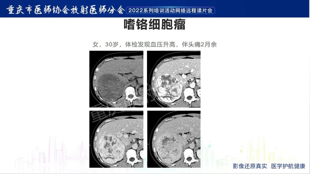 影像PPT - 【病例】肾上腺皮质嗜酸细胞腺瘤1例CT-27