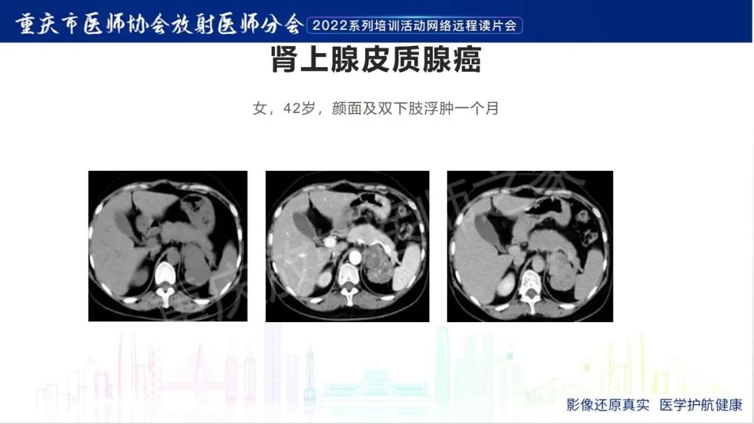 影像PPT - 【病例】肾上腺皮质嗜酸细胞腺瘤1例CT-29