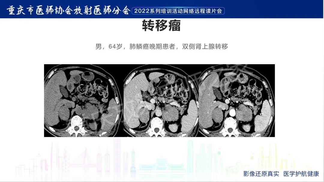 影像PPT - 【病例】肾上腺皮质嗜酸细胞腺瘤1例CT-31