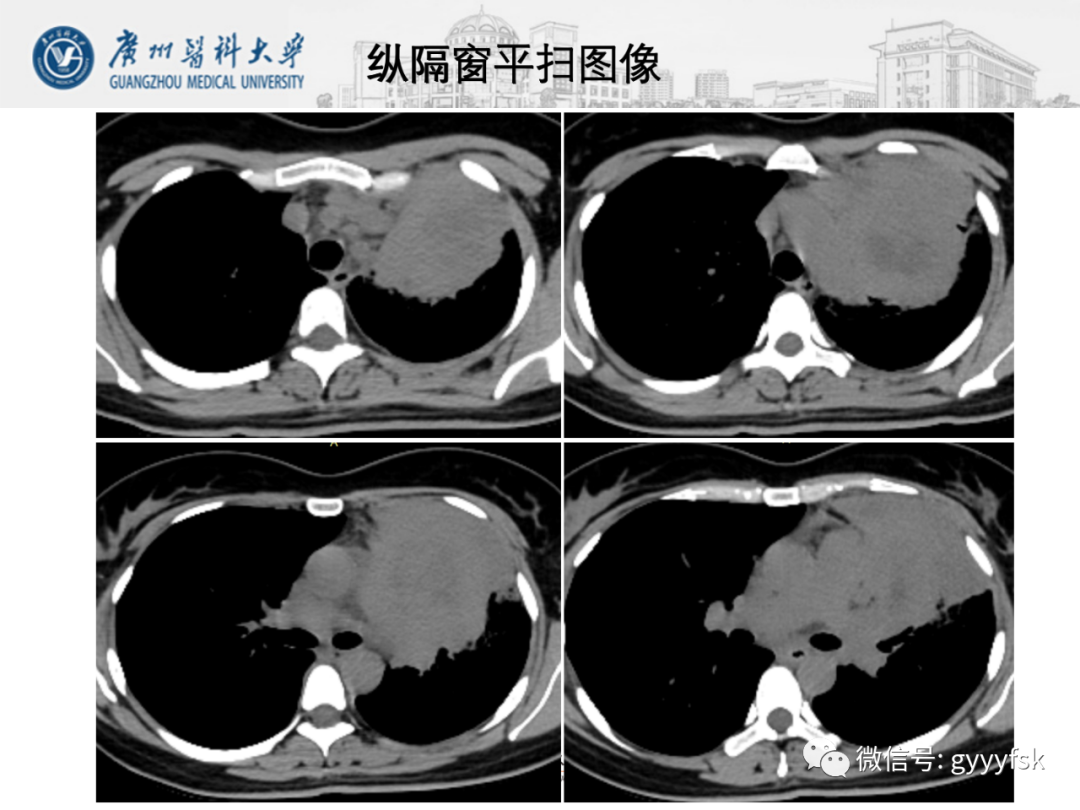 影像PPT - 【病例】纵隔淋巴瘤弥漫大B细胞淋巴瘤1例CT影像-5