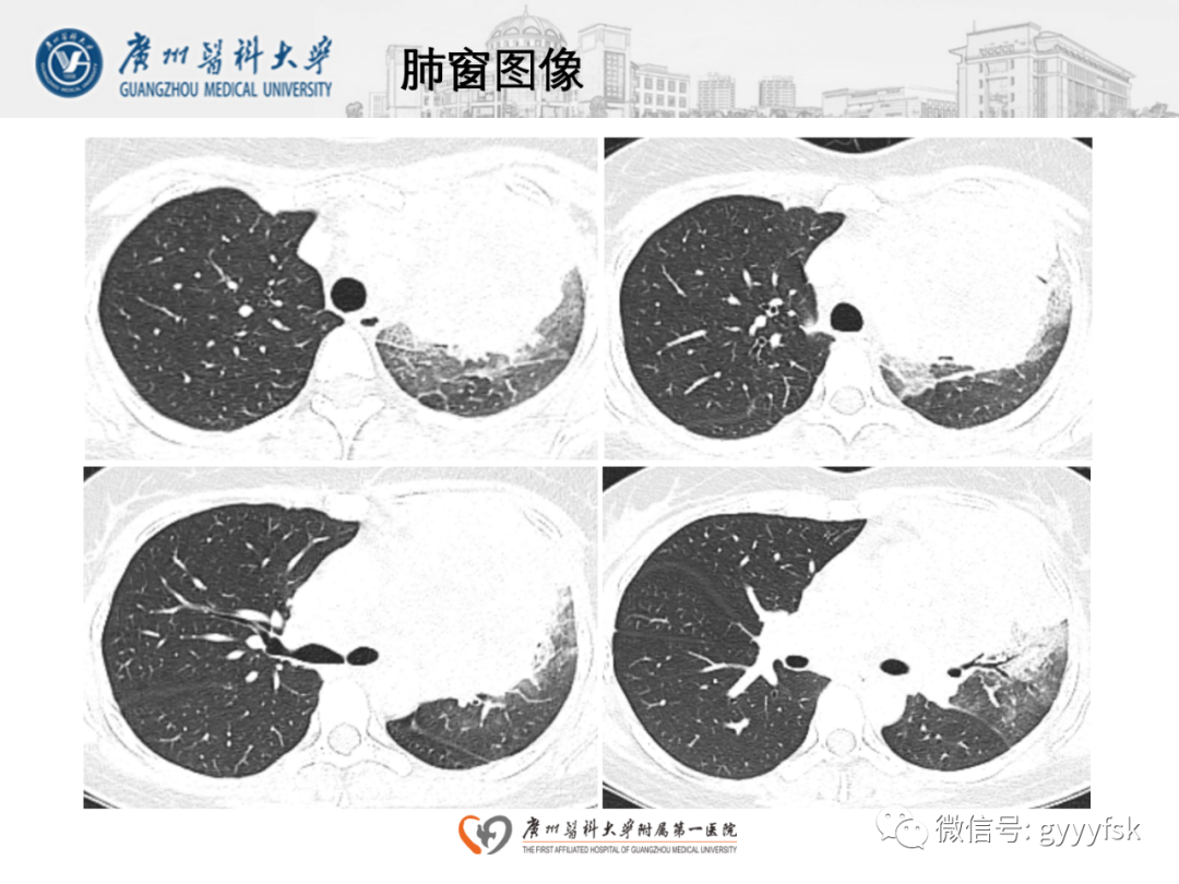 影像PPT - 【病例】纵隔淋巴瘤弥漫大B细胞淋巴瘤1例CT影像-4