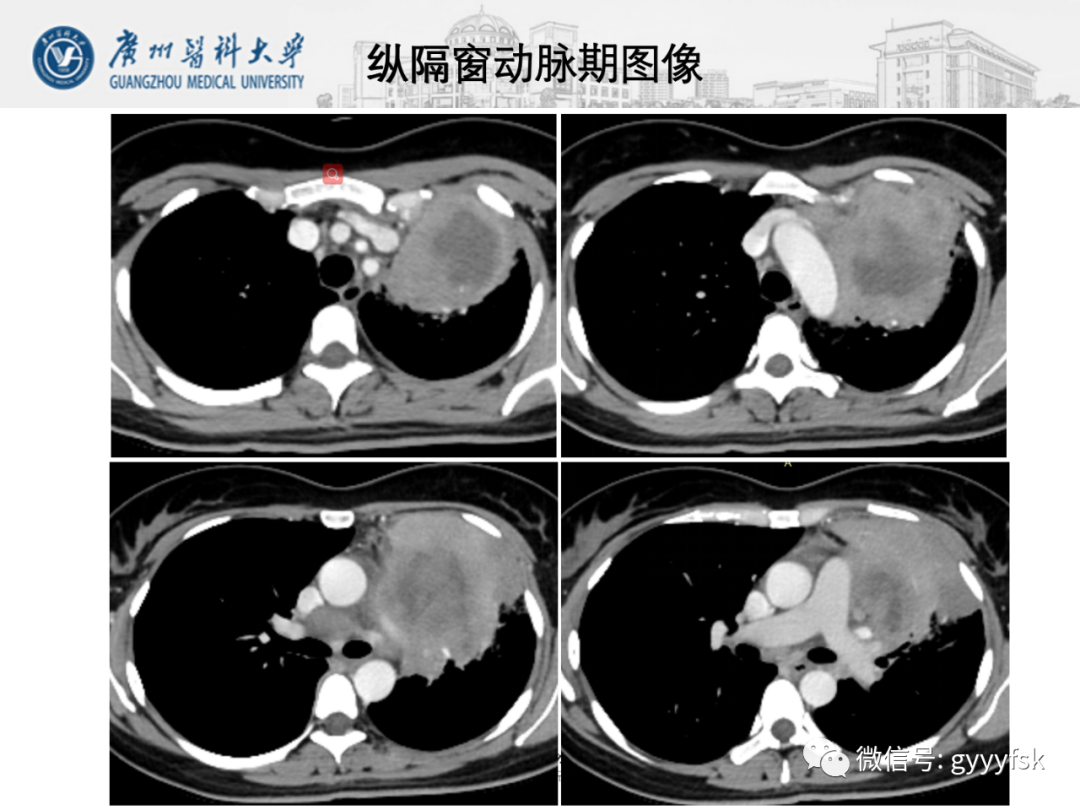 影像PPT - 【病例】纵隔淋巴瘤弥漫大B细胞淋巴瘤1例CT影像-6