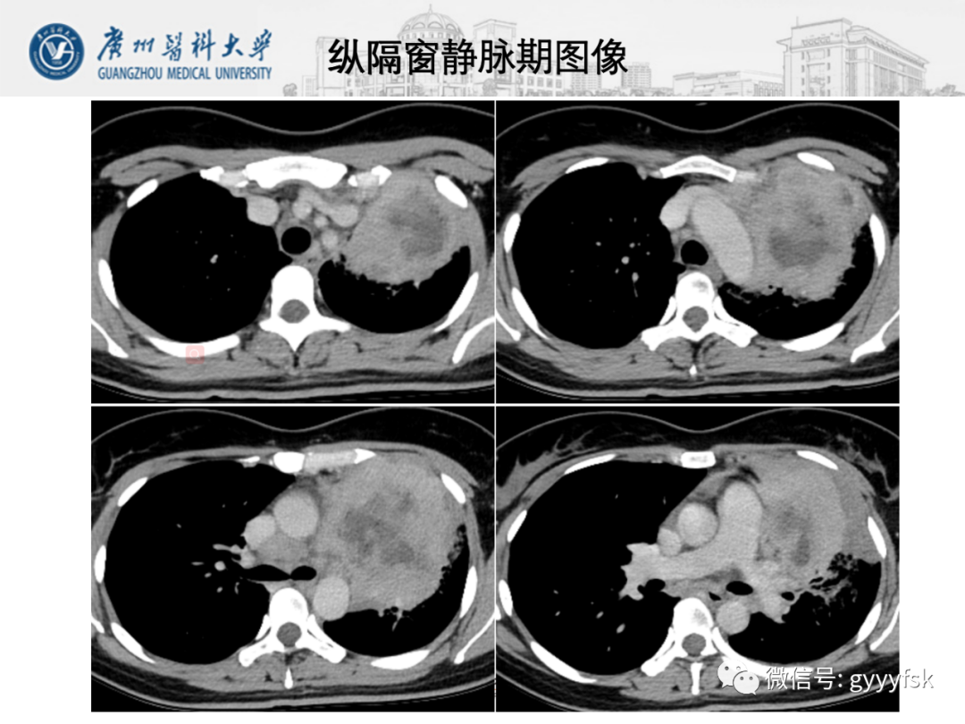 影像PPT - 【病例】纵隔淋巴瘤弥漫大B细胞淋巴瘤1例CT影像-7