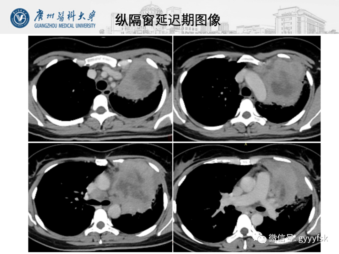 影像PPT - 【病例】纵隔淋巴瘤弥漫大B细胞淋巴瘤1例CT影像-8