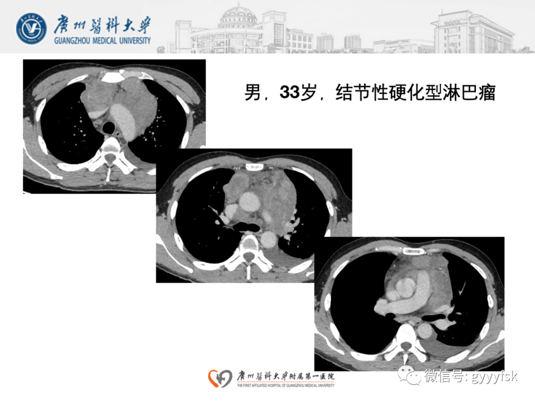 影像PPT - 【病例】纵隔淋巴瘤弥漫大B细胞淋巴瘤1例CT影像-14