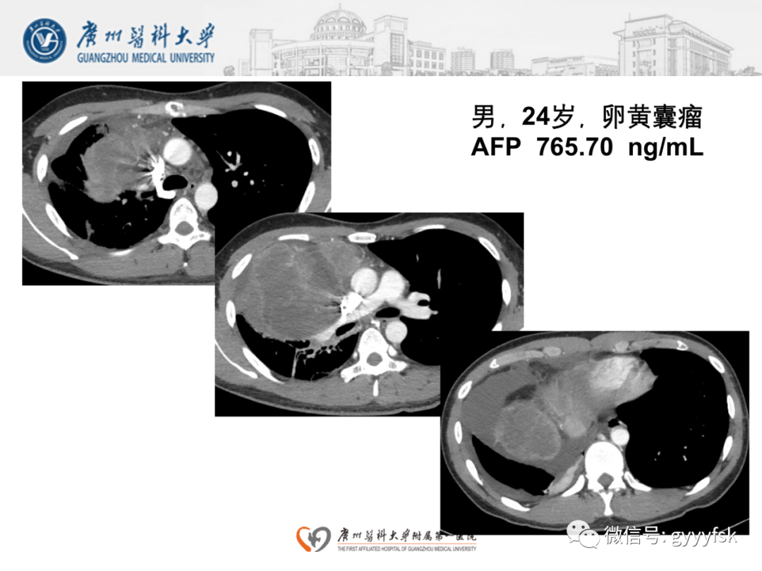 影像PPT - 【病例】纵隔淋巴瘤弥漫大B细胞淋巴瘤1例CT影像-17