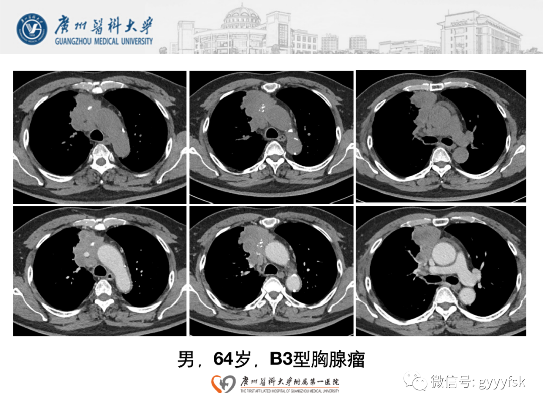 影像PPT - 【病例】纵隔淋巴瘤弥漫大B细胞淋巴瘤1例CT影像-19