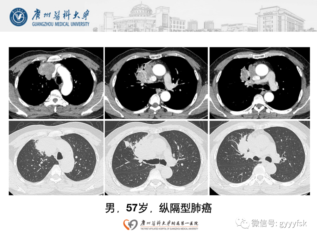 影像PPT - 【病例】纵隔淋巴瘤弥漫大B细胞淋巴瘤1例CT影像-21