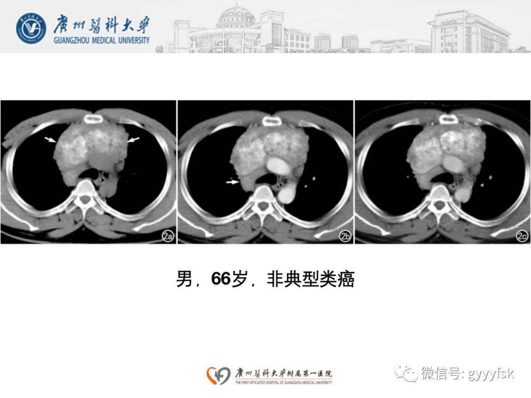 影像PPT - 【病例】纵隔淋巴瘤弥漫大B细胞淋巴瘤1例CT影像-23