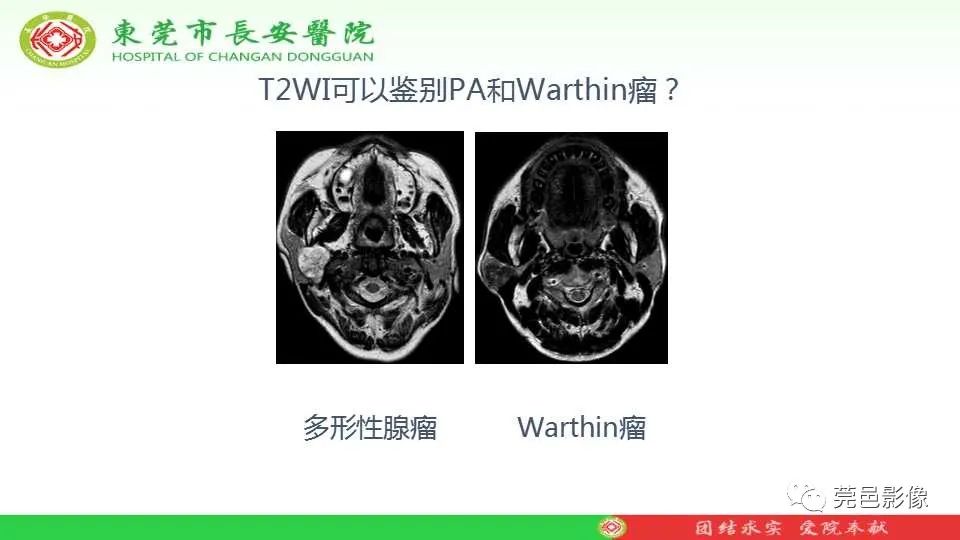 影像PPT - 【PPT】IVIM-DWI多参数鉴别多形性腺瘤和Warthin瘤-6