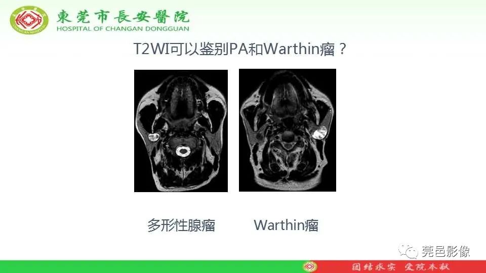 影像PPT - 【PPT】IVIM-DWI多参数鉴别多形性腺瘤和Warthin瘤-7
