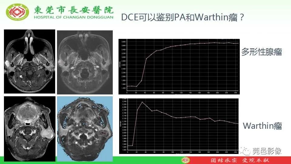 影像PPT - 【PPT】IVIM-DWI多参数鉴别多形性腺瘤和Warthin瘤-8