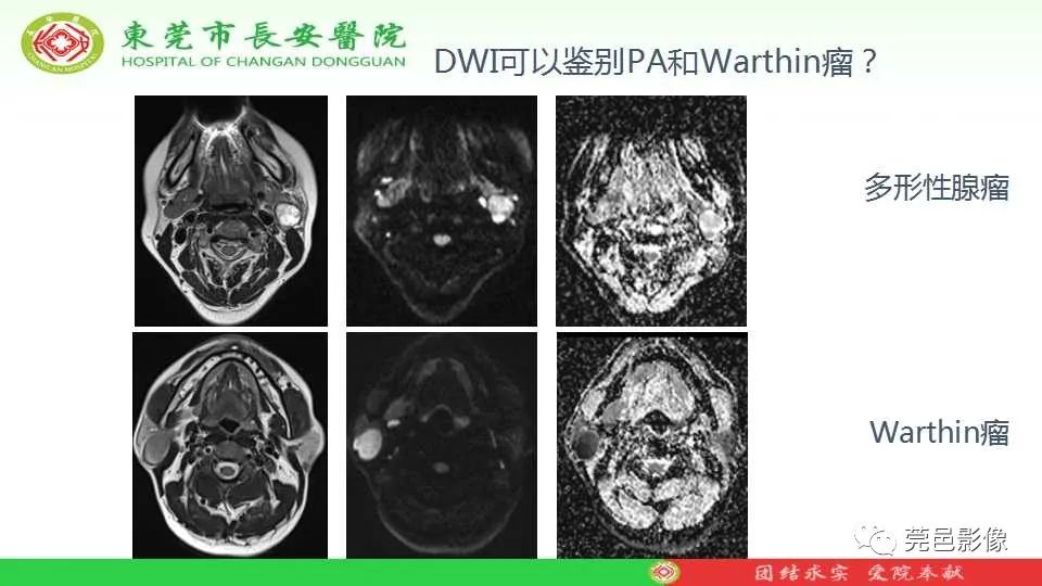 影像PPT - 【PPT】IVIM-DWI多参数鉴别多形性腺瘤和Warthin瘤-10