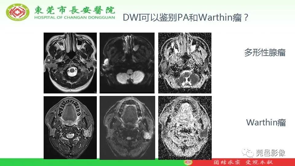影像PPT - 【PPT】IVIM-DWI多参数鉴别多形性腺瘤和Warthin瘤-11