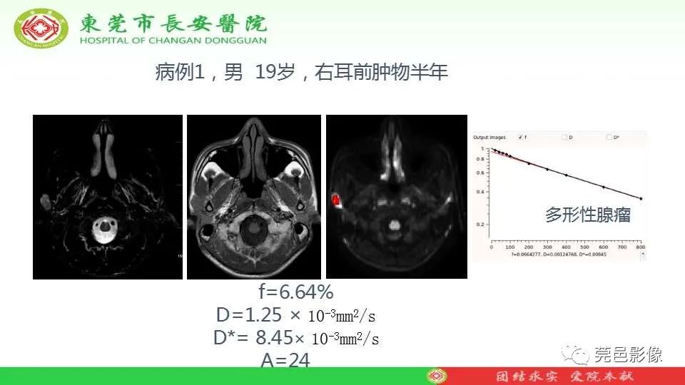 影像PPT - 【PPT】IVIM-DWI多参数鉴别多形性腺瘤和Warthin瘤-24