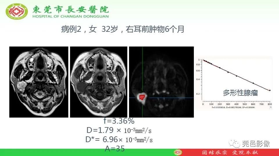 影像PPT - 【PPT】IVIM-DWI多参数鉴别多形性腺瘤和Warthin瘤-25