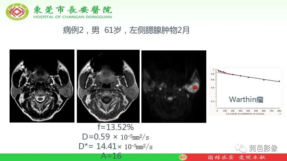 影像PPT - 【PPT】IVIM-DWI多参数鉴别多形性腺瘤和Warthin瘤-30