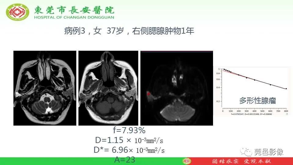 影像PPT - 【PPT】IVIM-DWI多参数鉴别多形性腺瘤和Warthin瘤-26