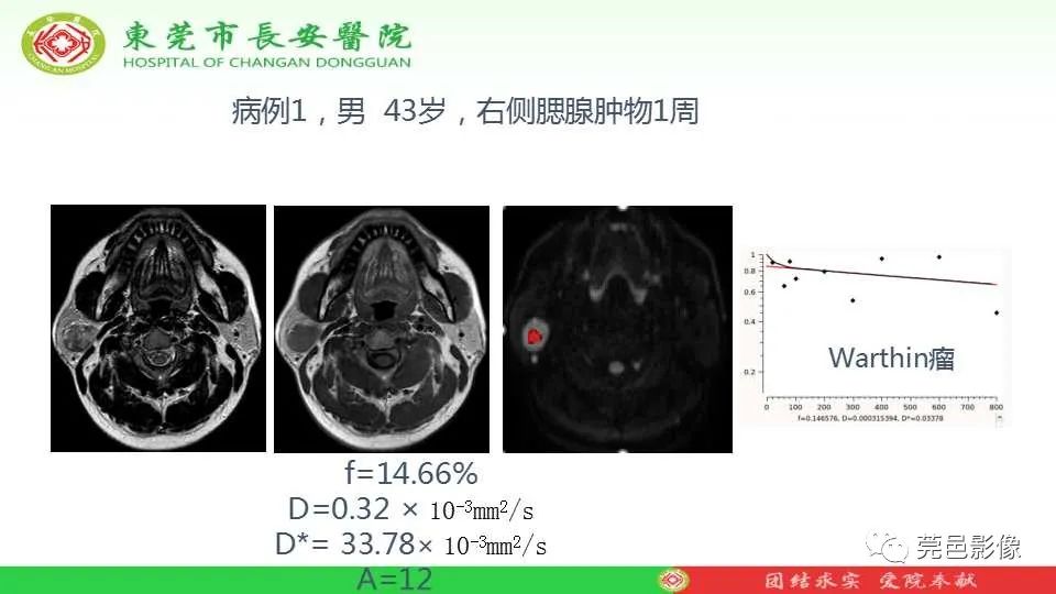 影像PPT - 【PPT】IVIM-DWI多参数鉴别多形性腺瘤和Warthin瘤-29