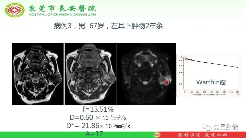 影像PPT - 【PPT】IVIM-DWI多参数鉴别多形性腺瘤和Warthin瘤-31
