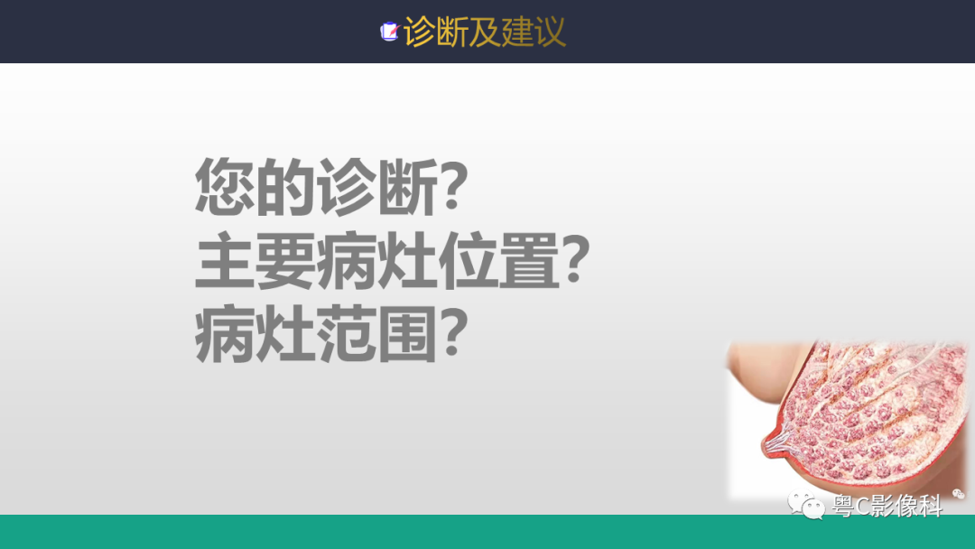 影像PPT - 【病例】浸润性乳腺癌1例X线钼靶MR影像表现-13