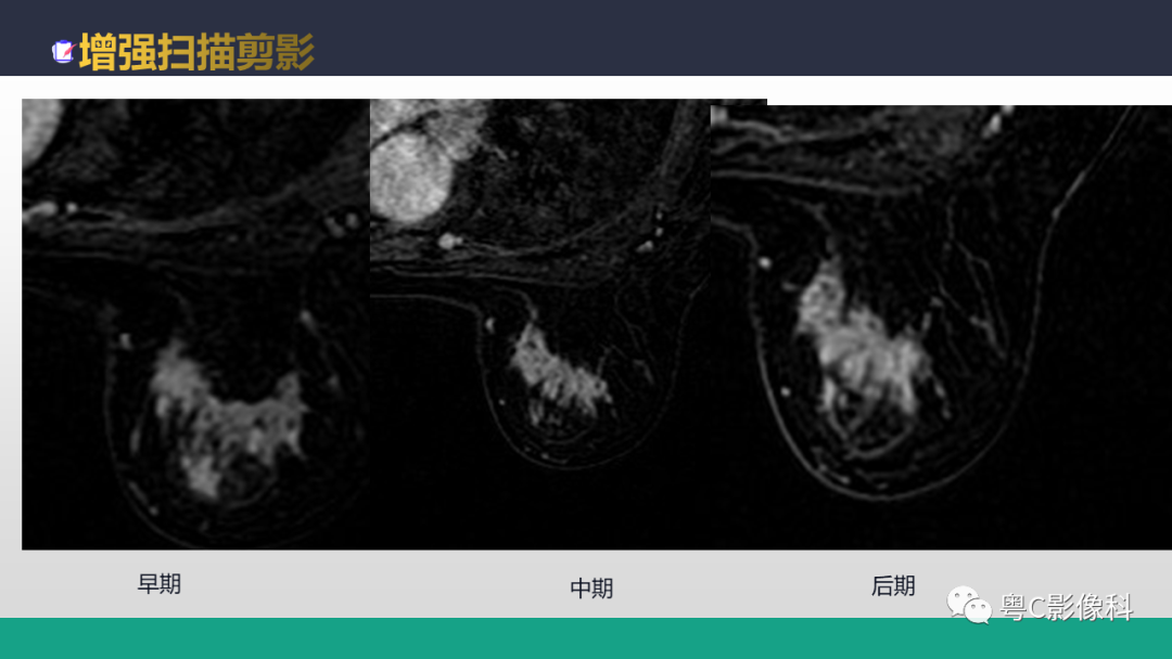 影像PPT - 【病例】浸润性乳腺癌1例X线钼靶MR影像表现-12