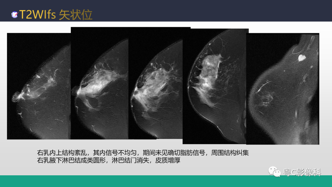 影像PPT - 【病例】浸润性乳腺癌1例X线钼靶MR影像表现-20