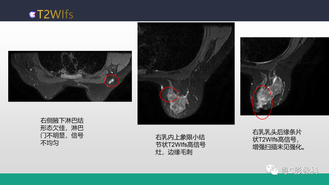 影像PPT - 【病例】浸润性乳腺癌1例X线钼靶MR影像表现-19
