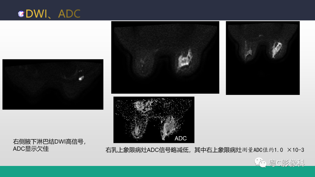 影像PPT - 【病例】浸润性乳腺癌1例X线钼靶MR影像表现-1