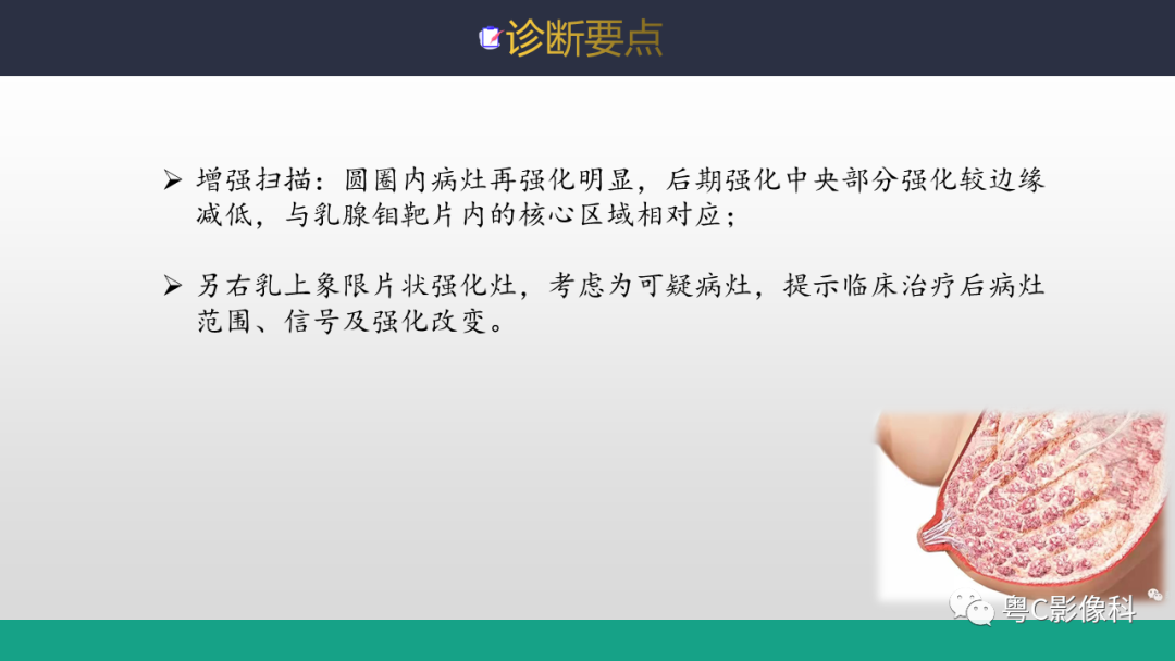 影像PPT - 【病例】浸润性乳腺癌1例X线钼靶MR影像表现-6