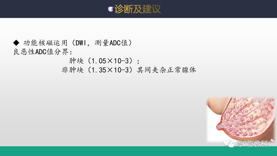 影像PPT - 【病例】浸润性乳腺癌1例X线钼靶MR影像表现-9