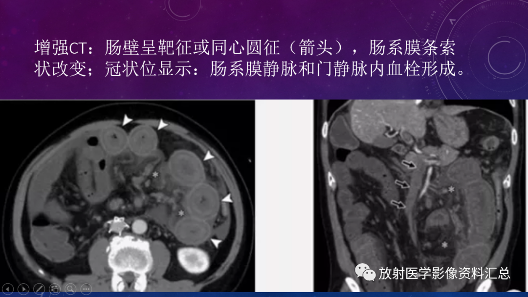 影像PPT - 【PPT】急性肠系膜缺血的CT影像诊断-7