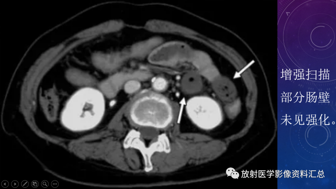 影像PPT - 【PPT】急性肠系膜缺血的CT影像诊断-9