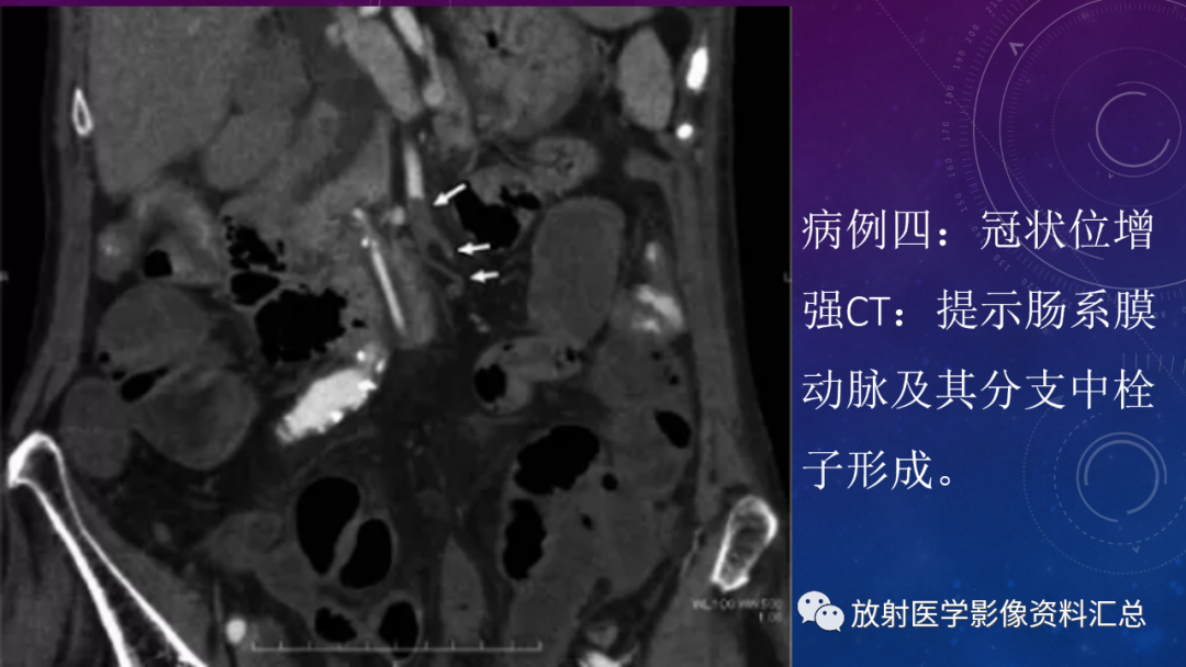 影像PPT - 【PPT】急性肠系膜缺血的CT影像诊断-11
