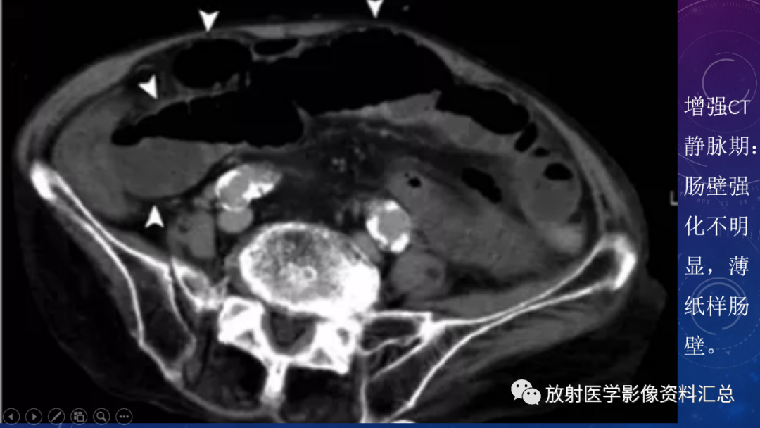 影像PPT - 【PPT】急性肠系膜缺血的CT影像诊断-12
