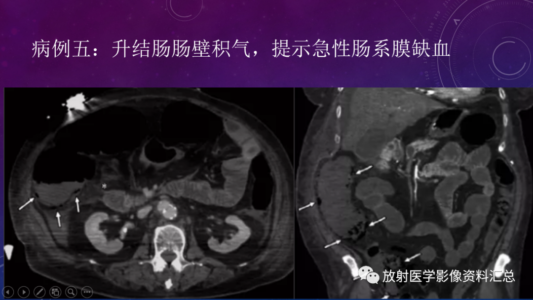 影像PPT - 【PPT】急性肠系膜缺血的CT影像诊断-13