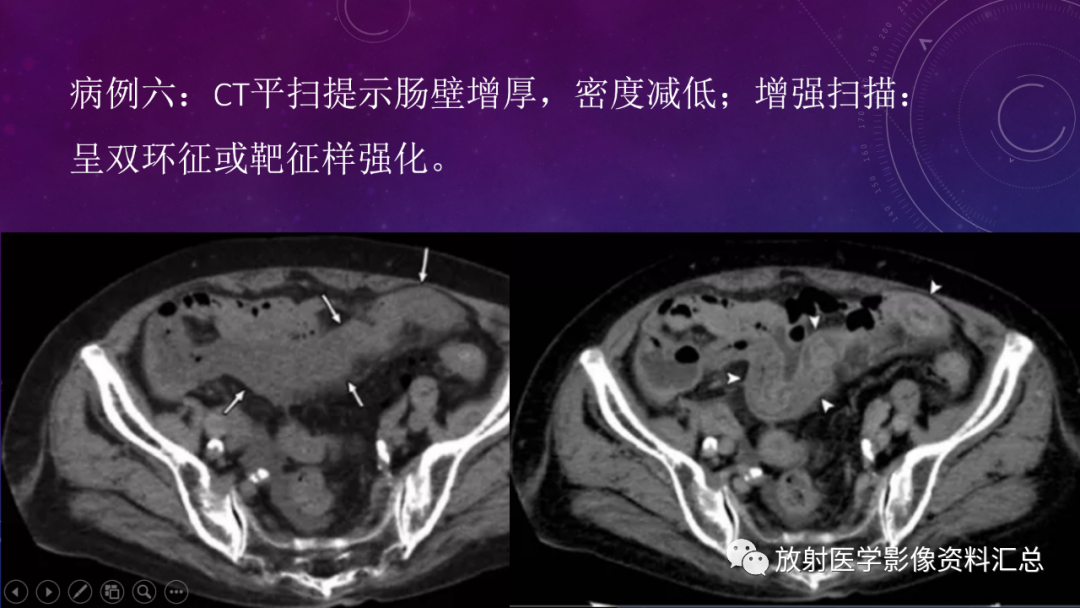 影像PPT - 【PPT】急性肠系膜缺血的CT影像诊断-14
