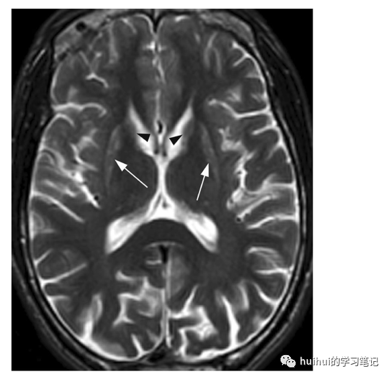 影像PPT - 基底神经节和丘脑（中央灰质）的双侧病变-8