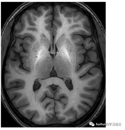 影像PPT - 基底神经节和丘脑（中央灰质）的双侧病变-13