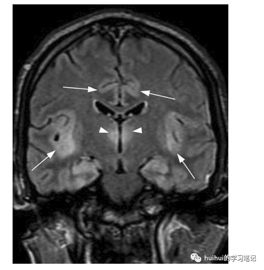 影像PPT - 基底神经节和丘脑（中央灰质）的双侧病变-24