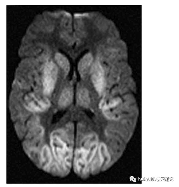 影像PPT - 基底神经节和丘脑（中央灰质）的双侧病变-44