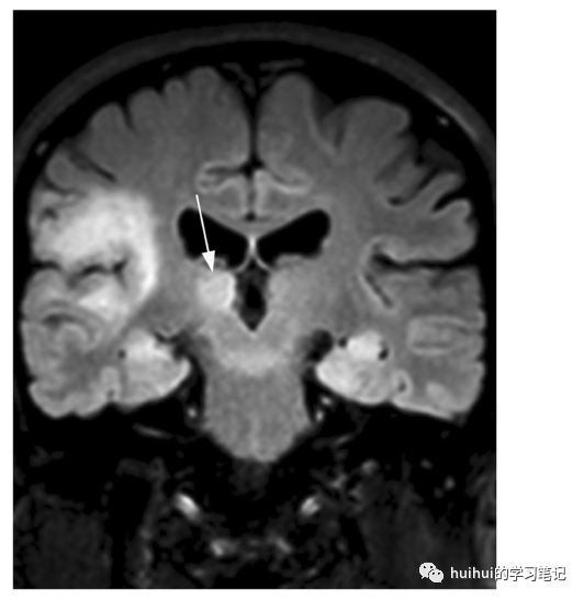 影像PPT - 基底神经节和丘脑（中央灰质）的双侧病变-46