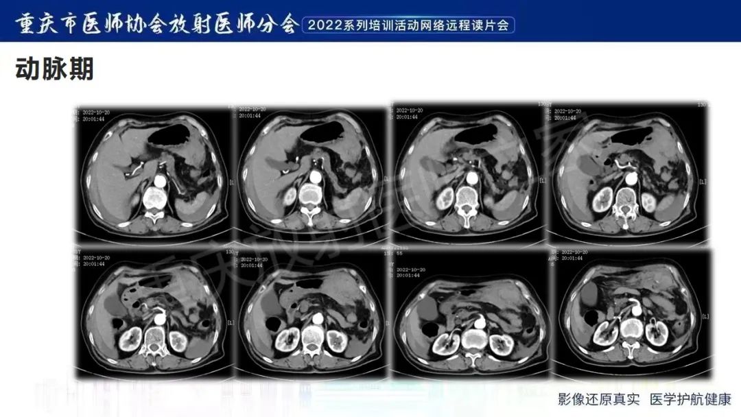 影像PPT - 【病例】腹腔胃大弯旁血肿1例CT影像-4